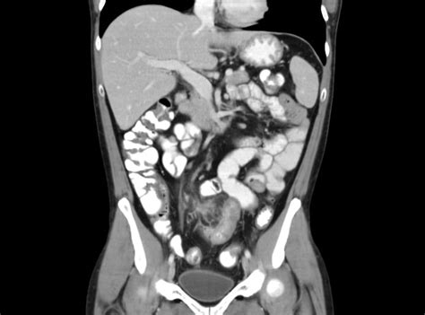 The Importance of Oral Contrast in CT Abdominal 